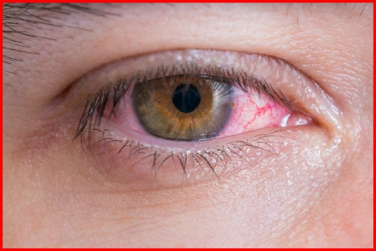 Os 10 Remédios Caseiros Para Tratar Olhos Vermelhos | Dr. Saúde